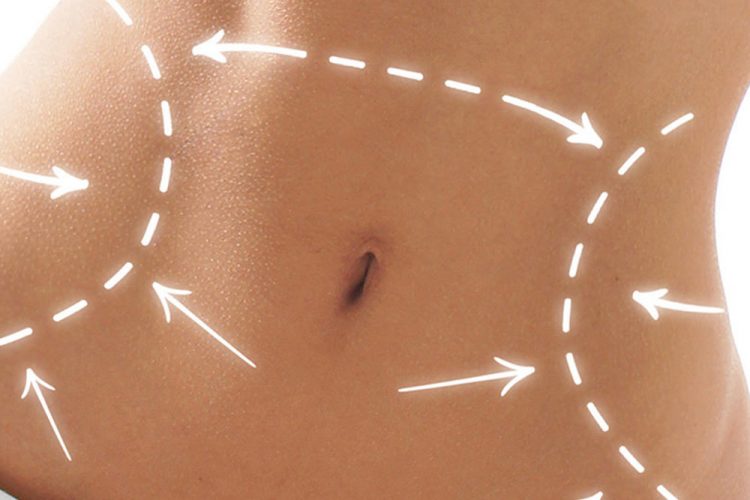 Tummy Tuck - Abdominaplasty Antalya